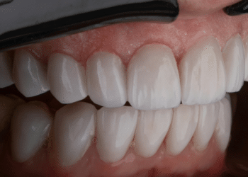 Different Methods for Achieving Proper Teeth Alignment