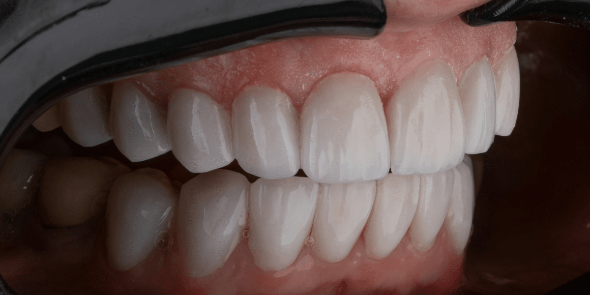 Different Methods for Achieving Proper Teeth Alignment