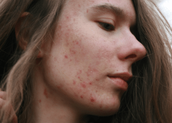 Emerging Tech Transforms Erythema Multiforme Care