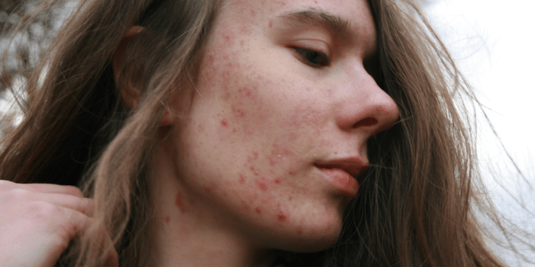 Emerging Tech Transforms Erythema Multiforme Care