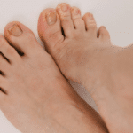 Diabetic Foot Complications A Statistical Overview