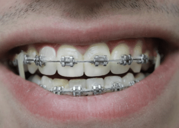 Things You Need to Know Before Getting Aesthetic Braces