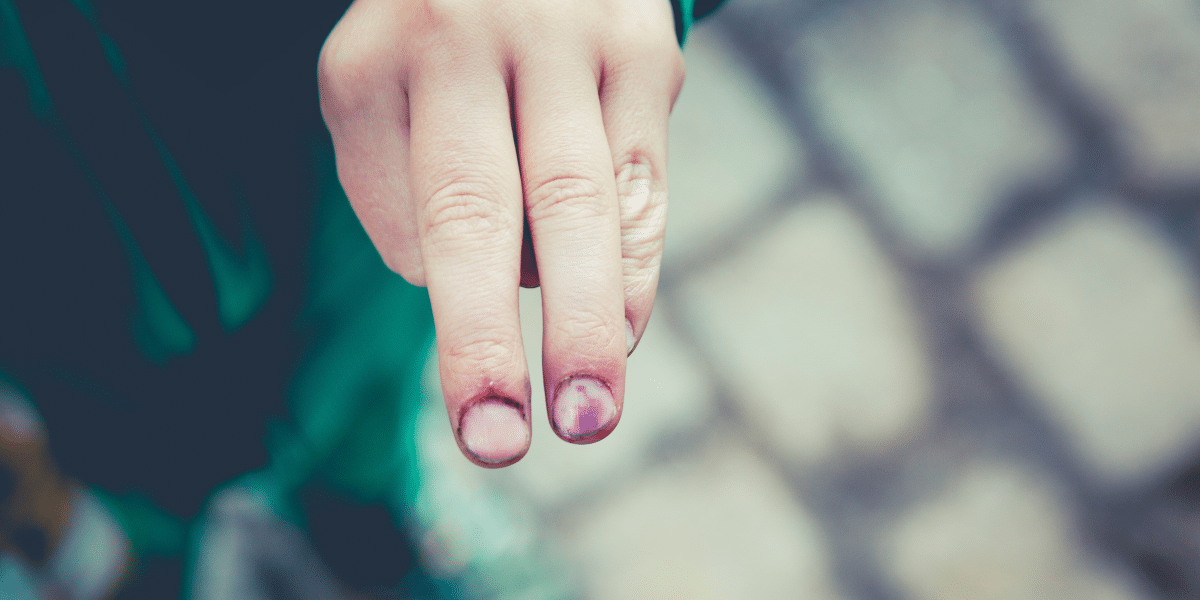 Understanding Severe Workplace Injuries Causes and Solutions