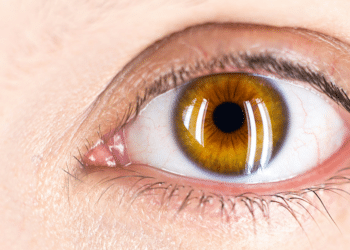 Eye Hygiene in Preventing Conjunctival Pigmentation