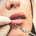 How Lip Fillers in Melbourne Are Transforming Beauty Trends