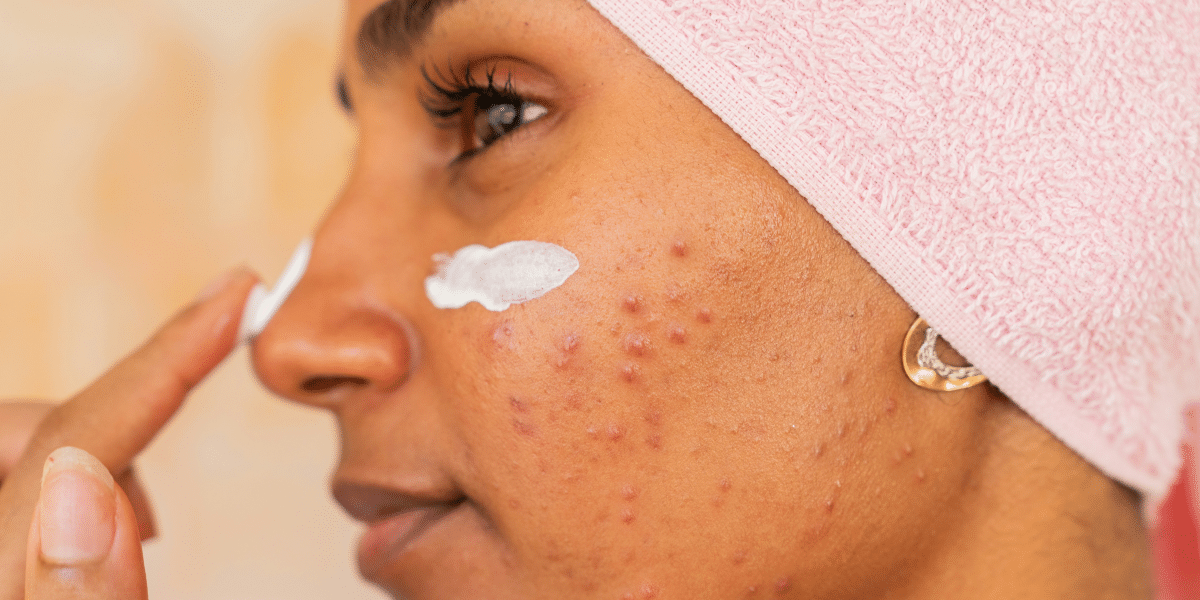 How to Start Using Retinol Without Freaking out Your Skin