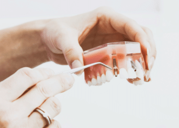 Dental Implants Replacing All Missing Teeth