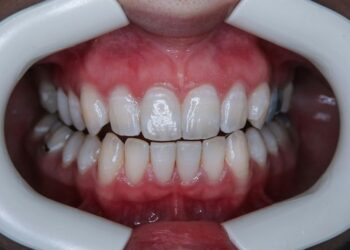 Is Professional Teeth Whitening in Miami Worth It?