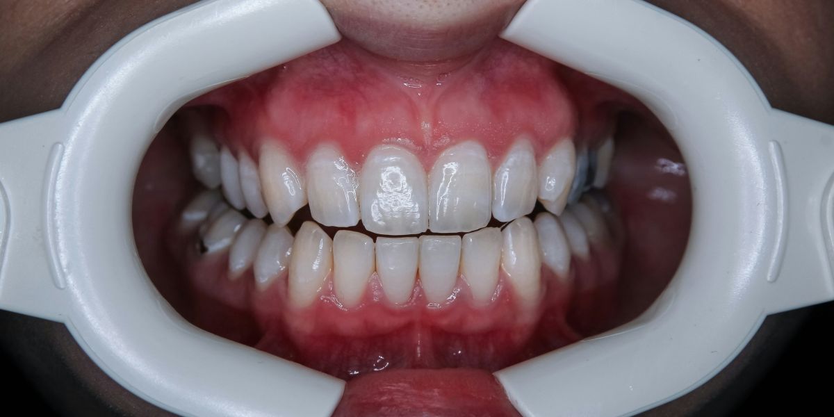 Is Professional Teeth Whitening in Miami Worth It?