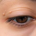 Understanding Eyelid Skin Tags and Other Benign Eyelid Growths