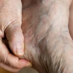 Before Treating Varicose Veins, Consider Diagnosis, Comfort, and Long-Term Results