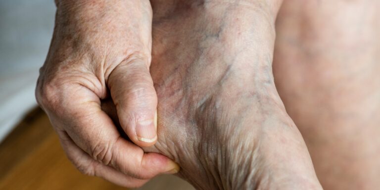 Before Treating Varicose Veins, Consider Diagnosis, Comfort, and Long-Term Results