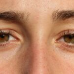 Under-Eye Bags and Their Causes, Treatment Options, and Prevention