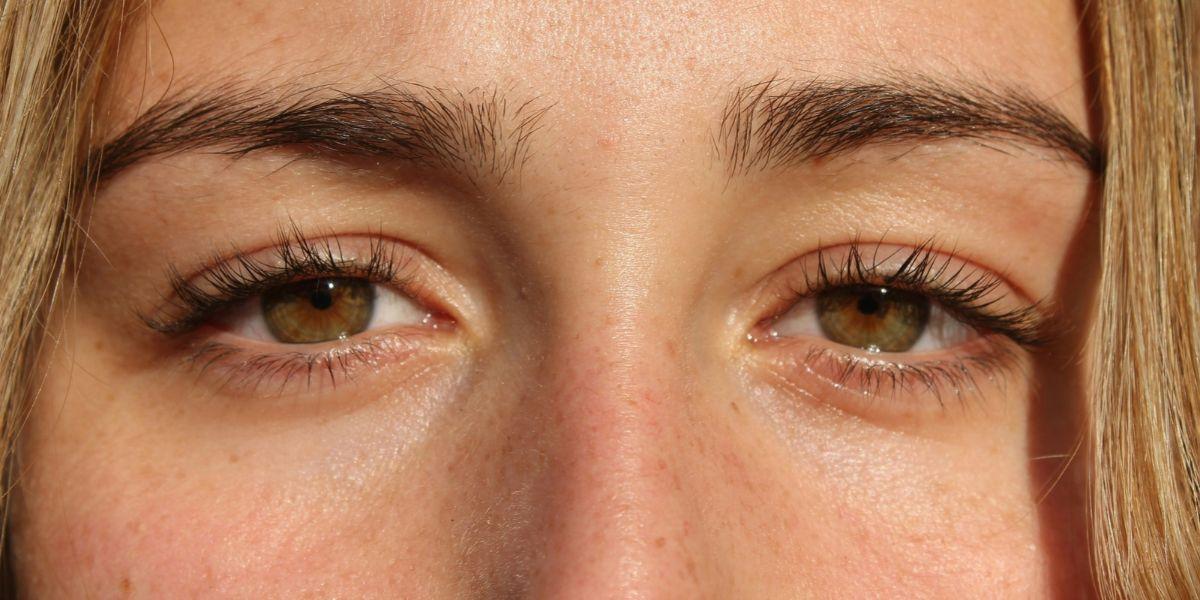 Under-Eye Bags and Their Causes, Treatment Options, and Prevention