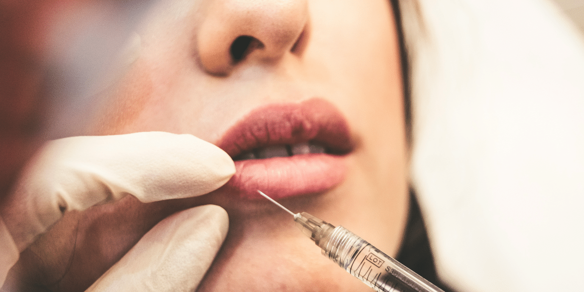 How Lip Fillers in Melbourne Are Transforming Beauty Trends