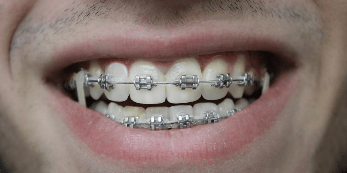 Things You Need to Know Before Getting Aesthetic Braces