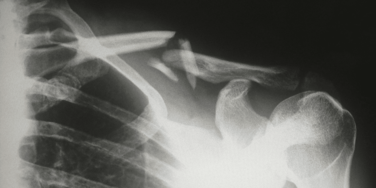 What Happens When a New York Resident is Injured While Vacationing in Florida