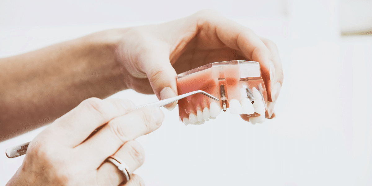 Dental Implants Replacing All Missing Teeth