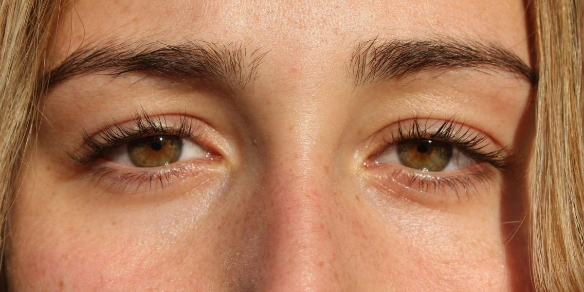 Under-Eye Bags and Their Causes, Treatment Options, and Prevention